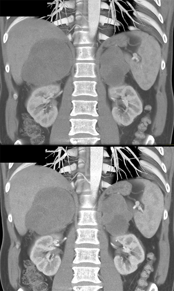 Large Adrenal Masses