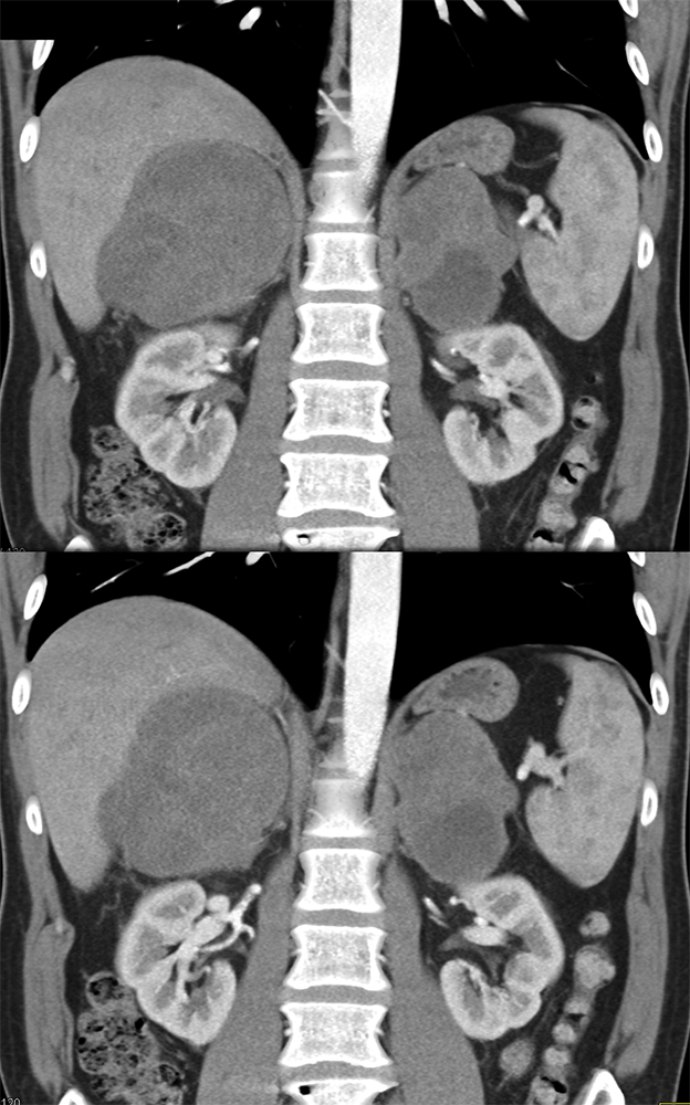 Large Adrenal Masses