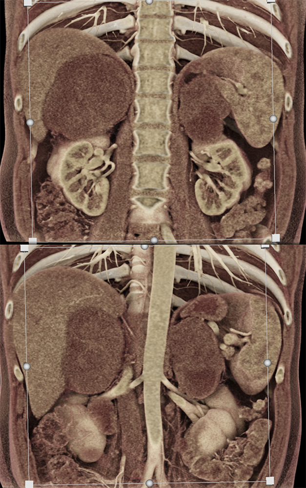 Large Adrenal Masses