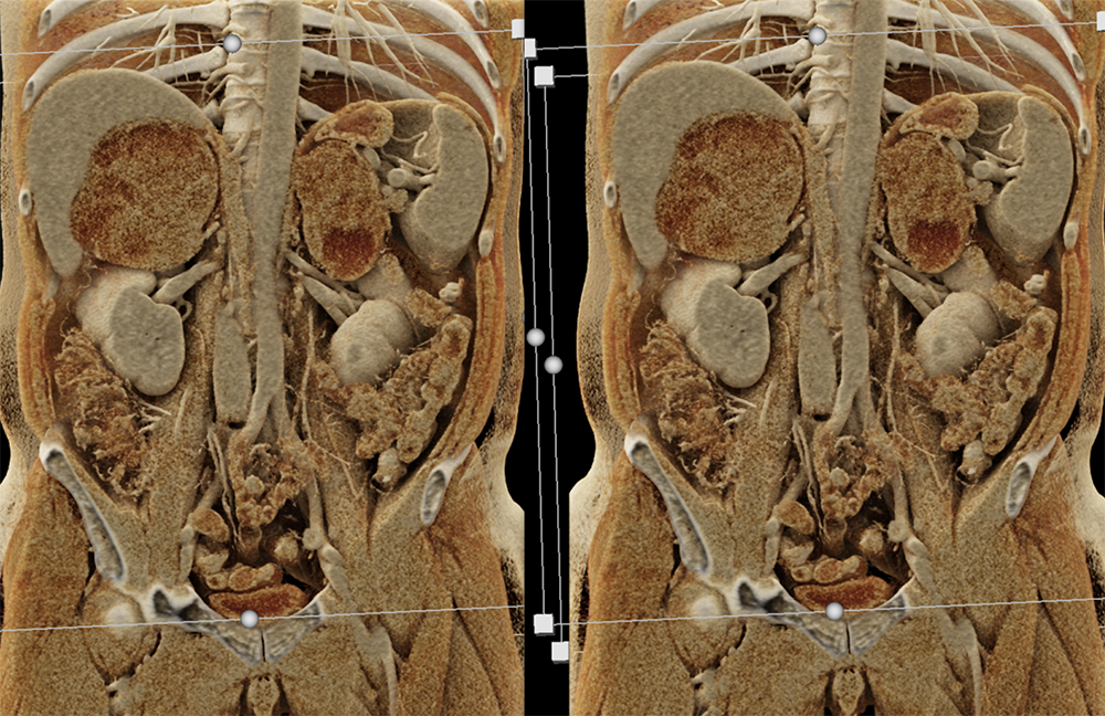 Large Adrenal Masses