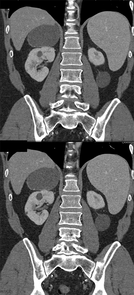 Large Adrenal Masses