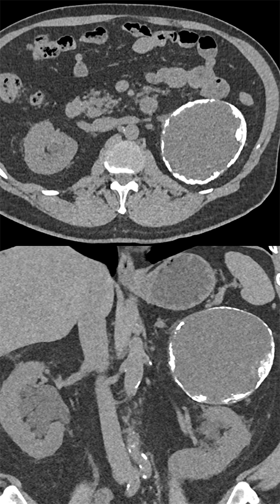 Large Adrenal Masses