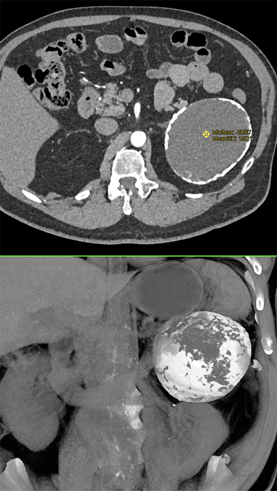 Large Adrenal Masses