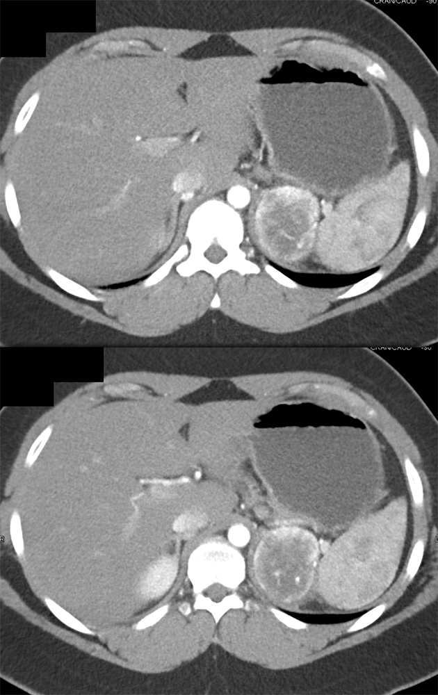 VHL with Bilateral Pheo and Bilateral RCCs