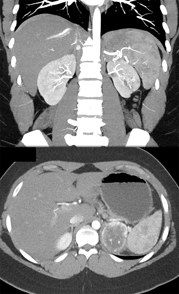 Large Adrenal Masses