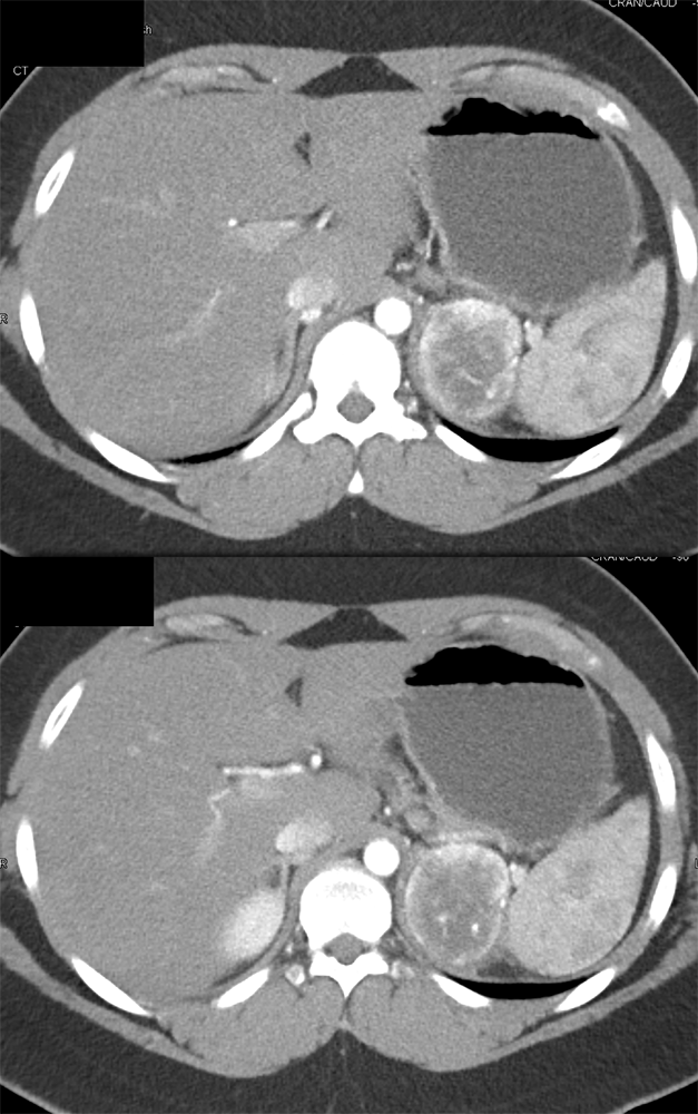 Large Adrenal Masses