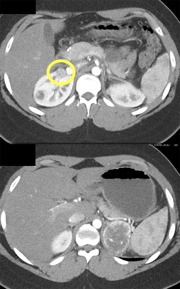 Large Adrenal Masses