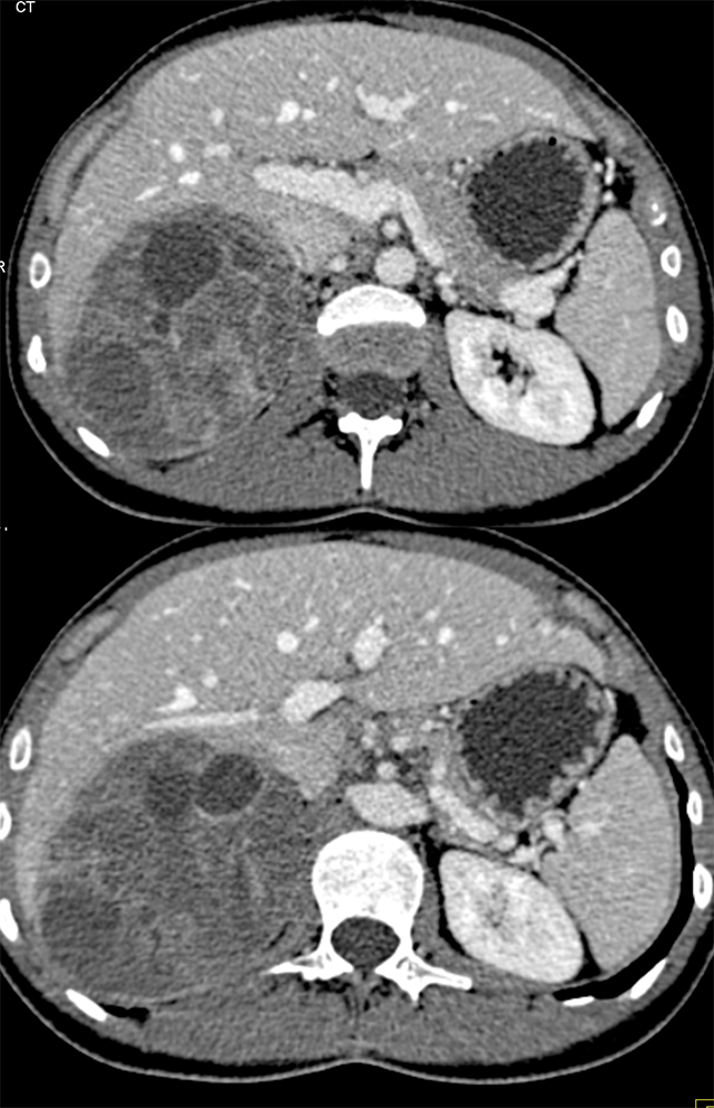 Large Adrenal Masses