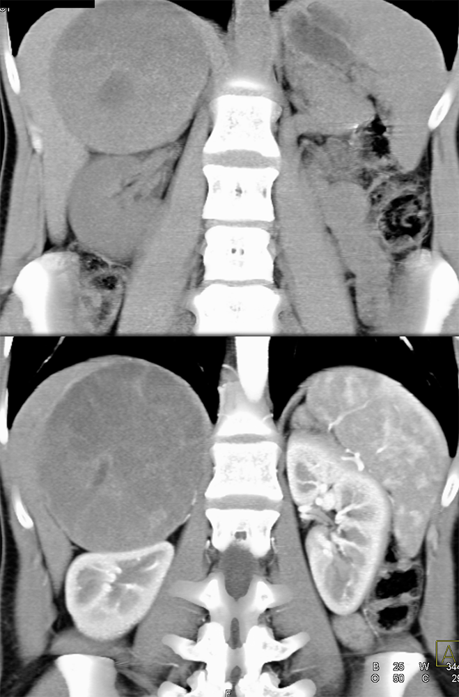 Large Adrenal Masses