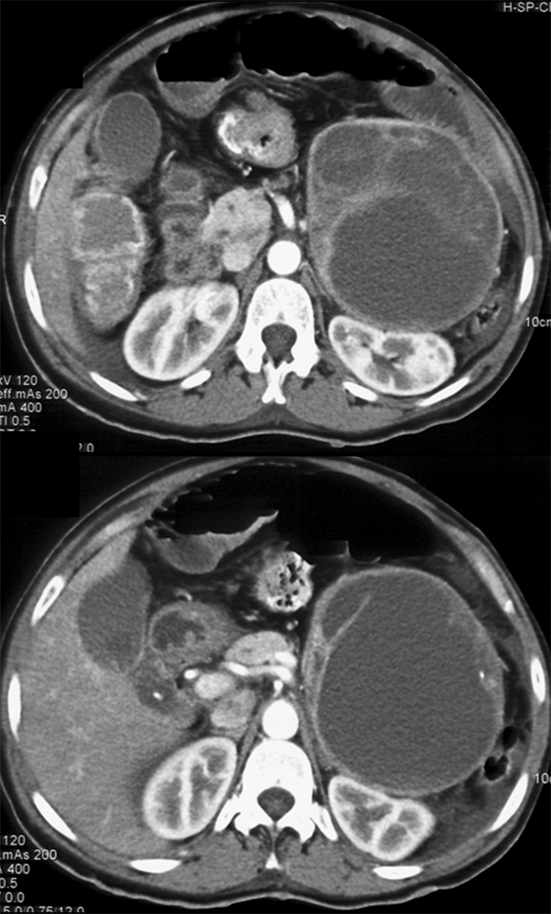 Incidental Pheochromocytoma