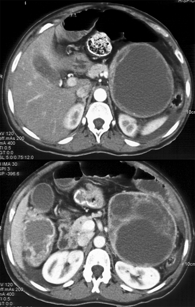 Large Adrenal Masses