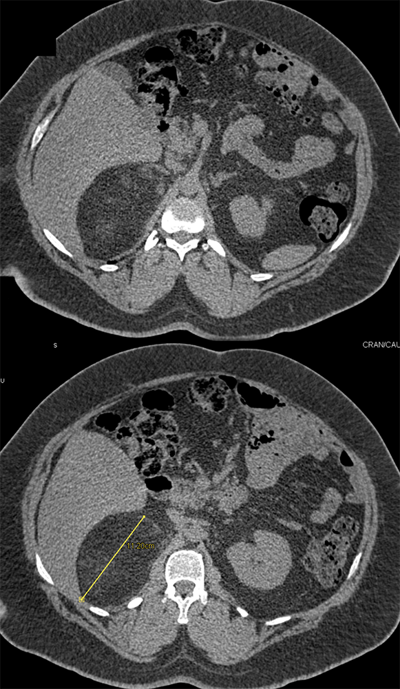 Adrenal Myelolipoma 