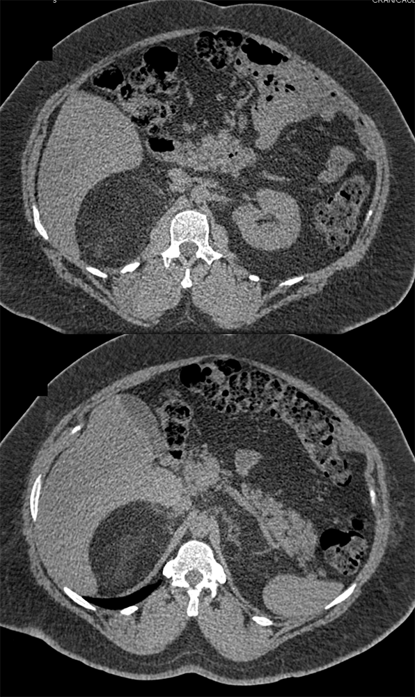 Large Adrenal Masses