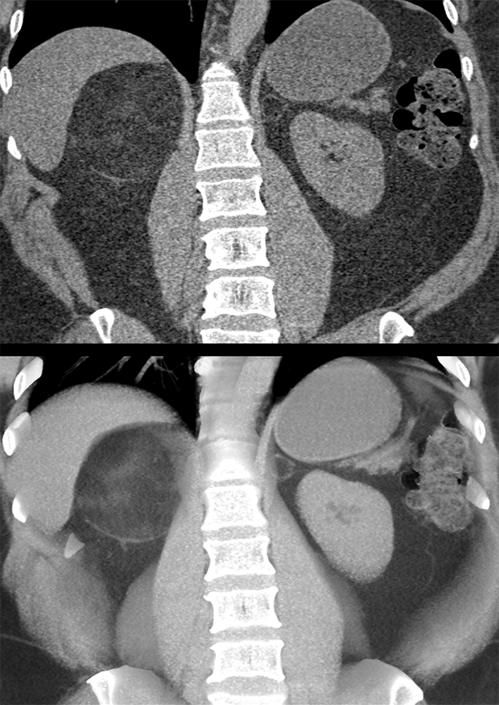 Large Adrenal Masses