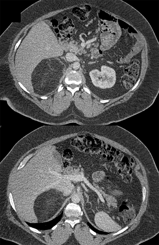 Large Adrenal Masses