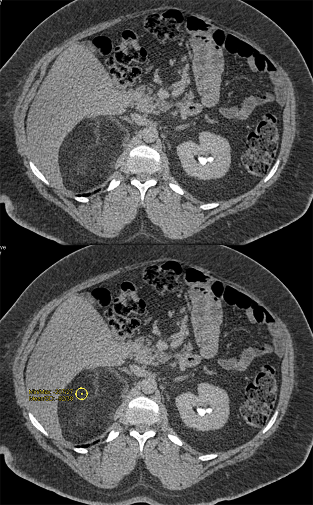 Large Adrenal Masses