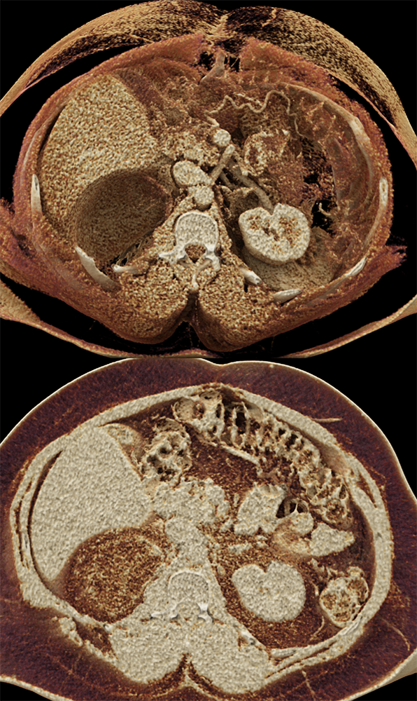 Large Adrenal Masses