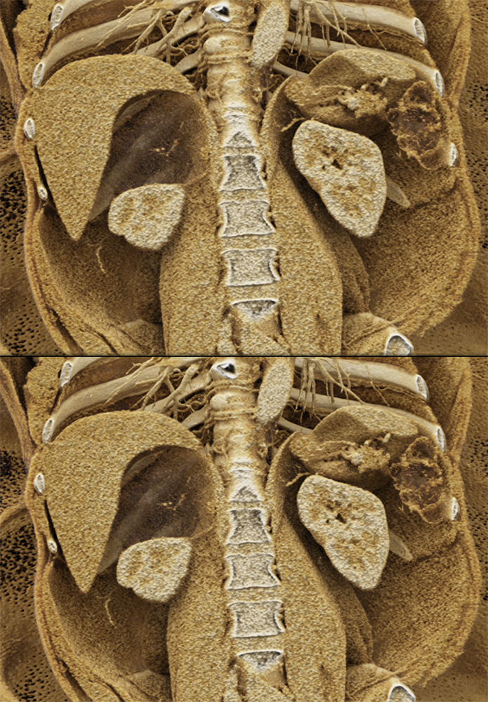 Large Adrenal Masses