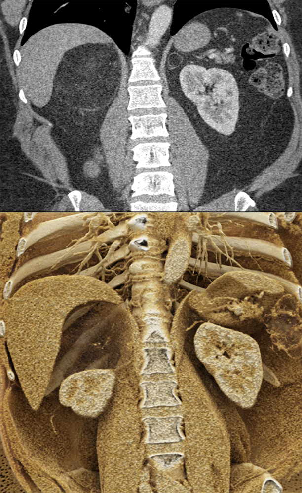 Large Adrenal Masses