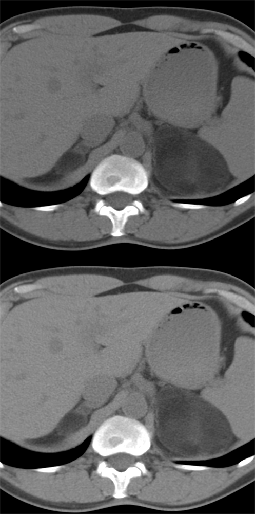 Bilateral Adrenal Myelolipomas