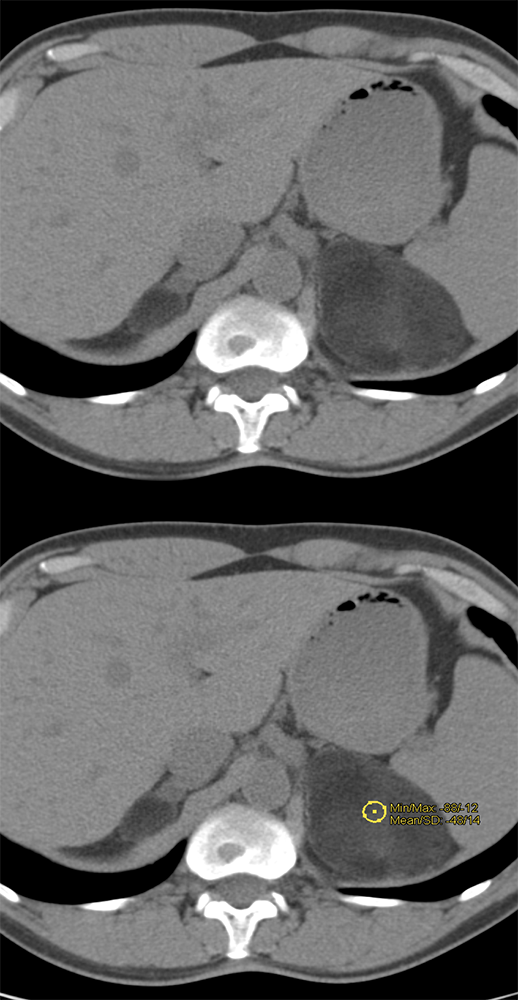 Large Adrenal Masses