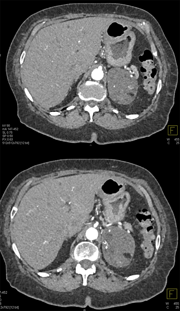 Large Adrenal Myelolipoma