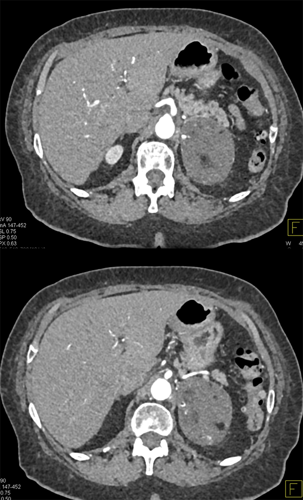 Large Adrenal Masses