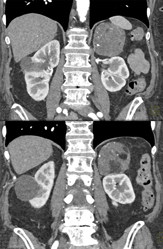 Large Adrenal Masses