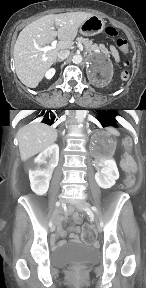 Large Adrenal Masses