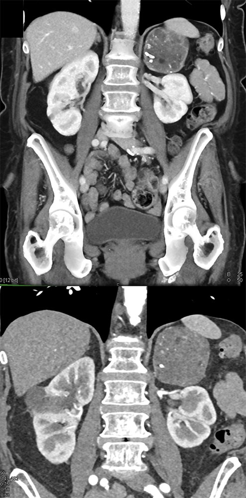 Large Adrenal Masses