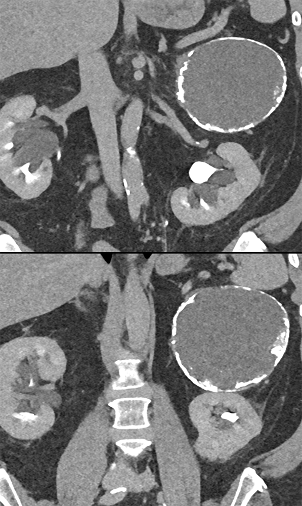 Large Adrenal Masses