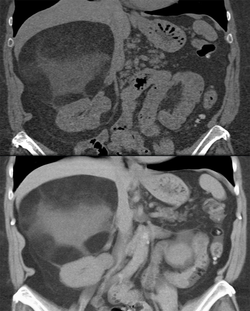 Large Adrenal Masses