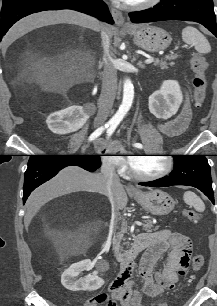 Large Adrenal Masses