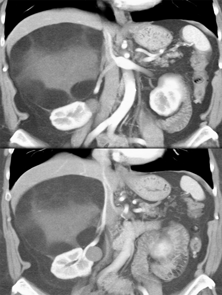 Large Adrenal Masses