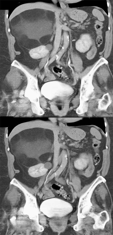 Large Adrenal Masses