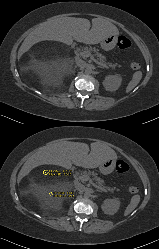 Myelolipoma that bleed