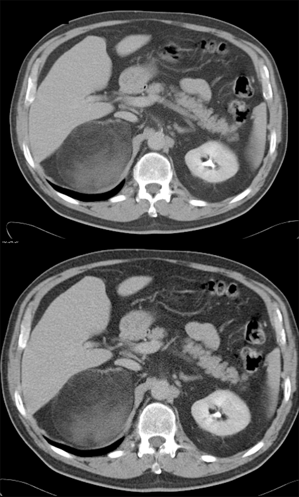 Adrenal Myelolipoma