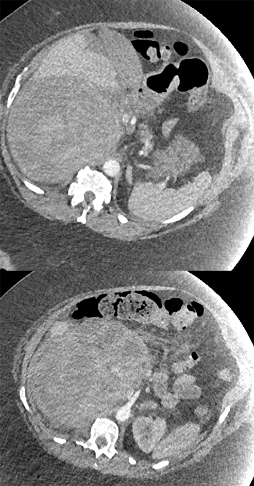 Adrenal Myelolipoma the Bleed with 2 Time Points