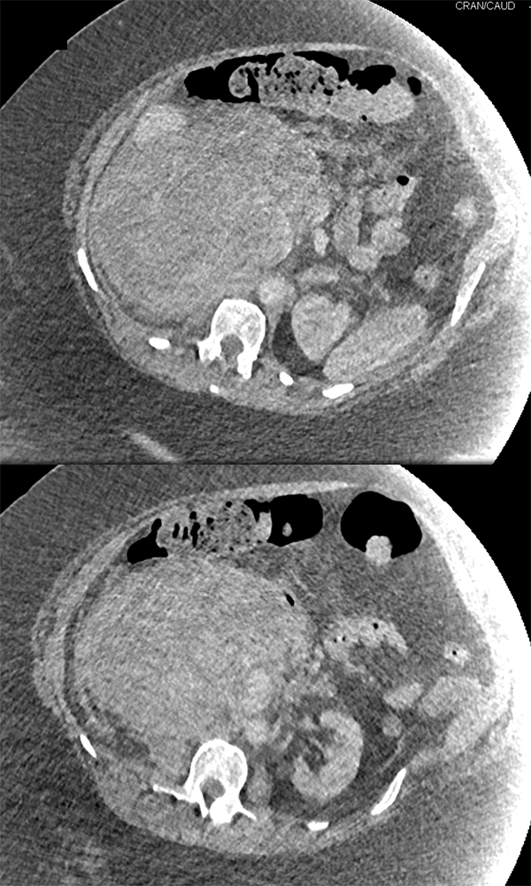 Large Adrenal Masses