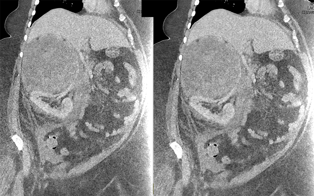 Large Adrenal Masses