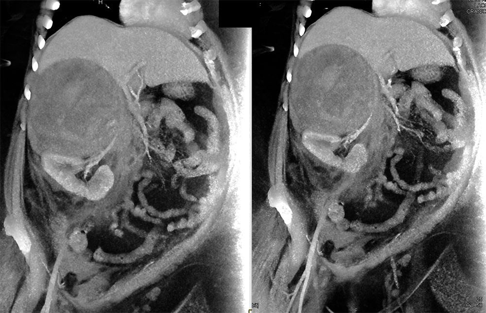 Large Adrenal Masses