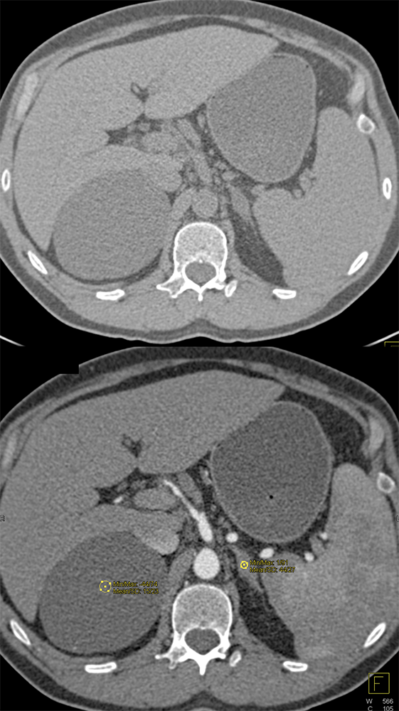 Adrenal Cyst