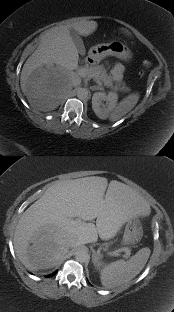 Large Adrenal Masses