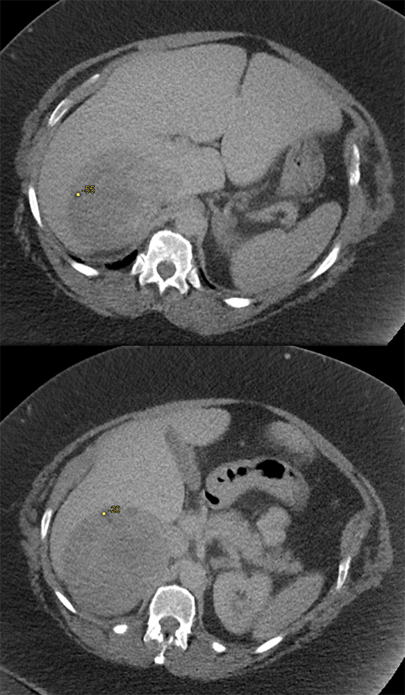 Large Adrenal Masses