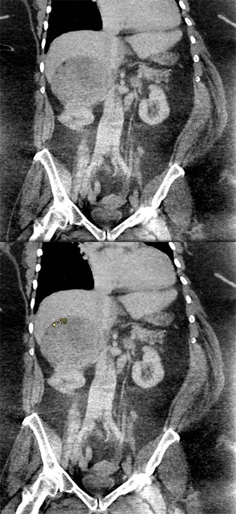 Large Adrenal Masses