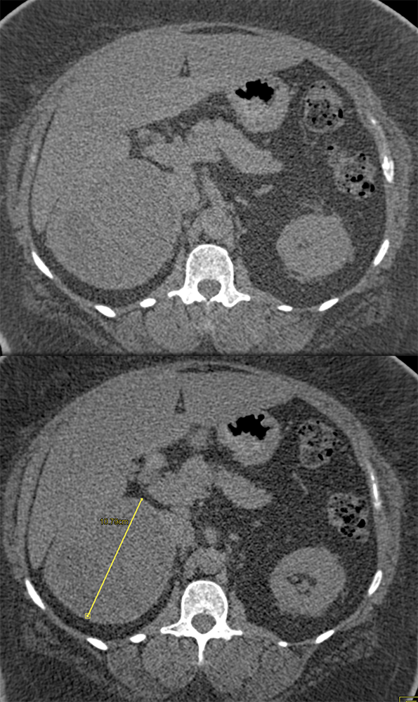 Adrenal Myelolipoma with Extramedullary Hematopoeisis