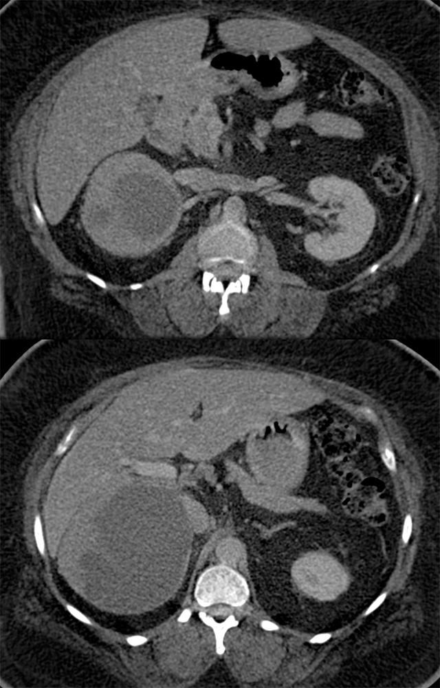 Large Adrenal Masses