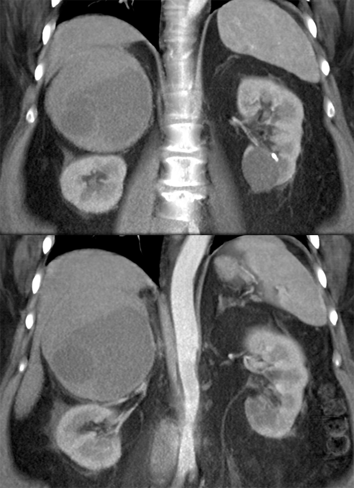 Large Adrenal Masses