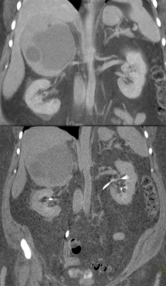 Large Adrenal Masses