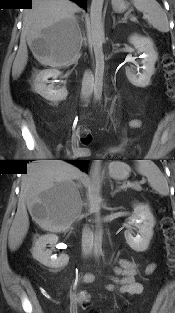 Large Adrenal Masses